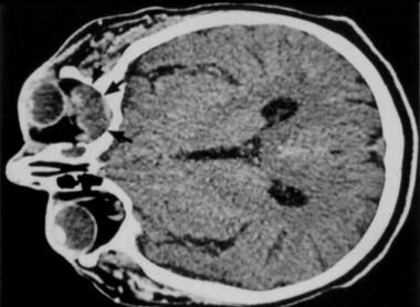 Orbital infections. Orbital abscess with significa