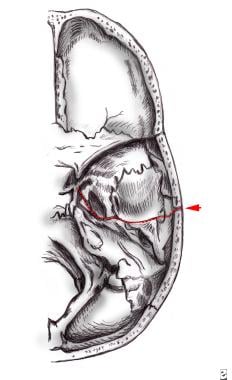 Fracture pattern of longitudinal temporal bone fra