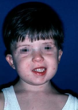 Child with velocardiofacial syndrome. Characterist
