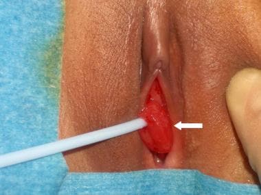 Urethral prolapse (arrow). 