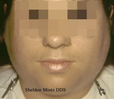 This patient with mumps has marked bilateral swell