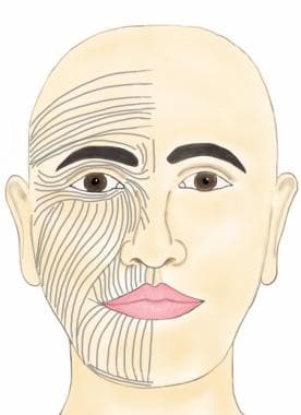 Skin tension lines of the face. An incision or a w