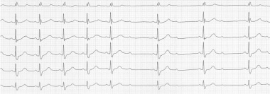 Atrioventricular Block. A constant PP interval and