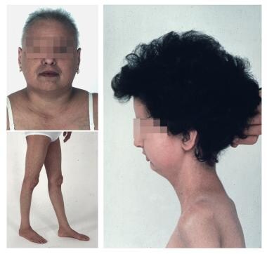Generalized Lipodystrophy. Werner syndrome in a 37