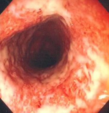 Kolonoskopisch dargestellte Colitis ulcerosa.