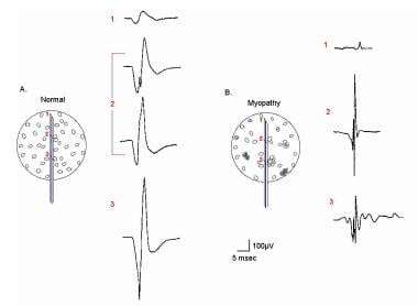 EMG evaluation of the MU: the electrophysiologic b