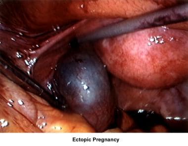 Infertility. Ectopic pregnancy. Image courtesy of 