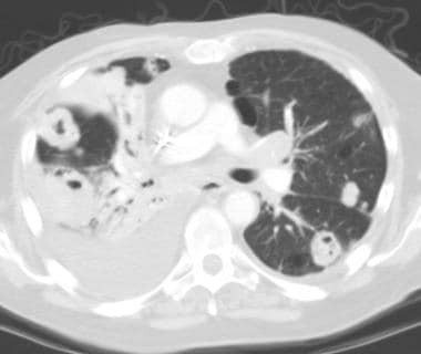 CT scan in a 58-year-old man with squamous cell ca