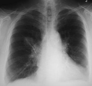 Solitary pulmonary nodule. Right upper lobe nodule