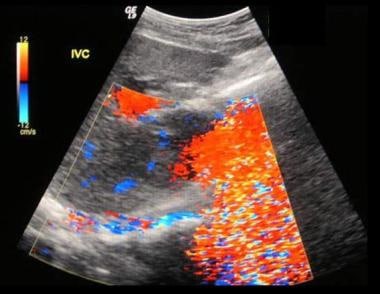 Budd-Chiari syndrome: The second of six ultrasound