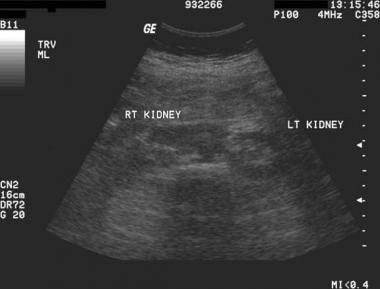 Transverse ultrasonogram of the abdomen showing a 