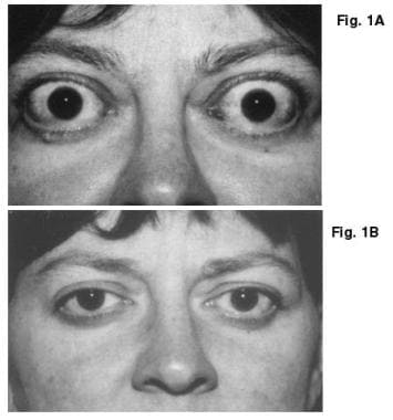 Frontal views of patient, taken (A) preoperatively