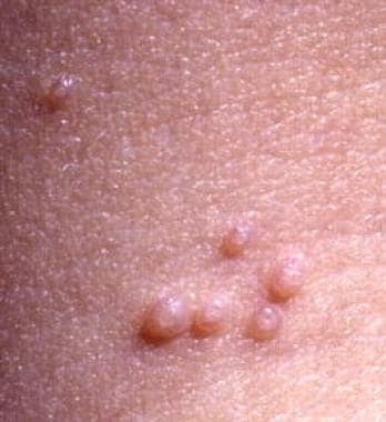 Molluscum Contagiosum Is a Viral Skin Infection - Verywell