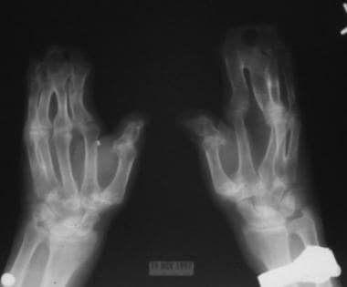 Note the osseous syndactyly involving the second, 