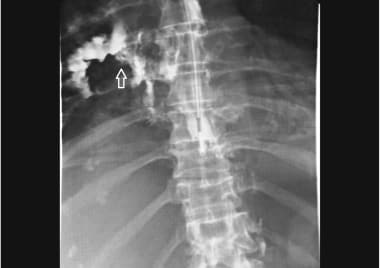 A case of esophageal perforation (1 of 2 images). 