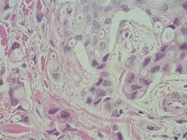 Breast cancer metastasis with hyperchromatic cells