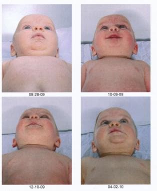 Postoperative pictures of the same child showing t