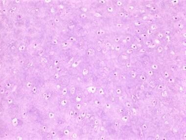 A focal increase in the cellularity of enchondroma