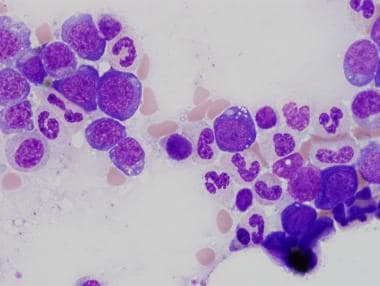 Pathology of therapy-related myeloid neoplasms. Nu