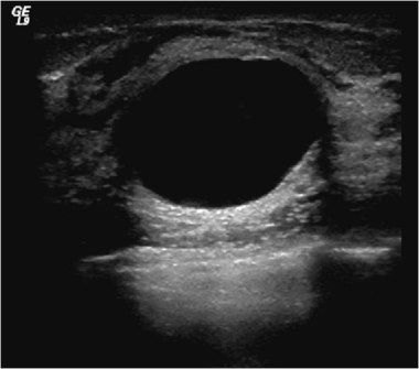 Ultrasound shows an anechoic cyst with smooth marg