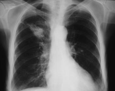 Right upper lobe mass. Features of the lesion are 