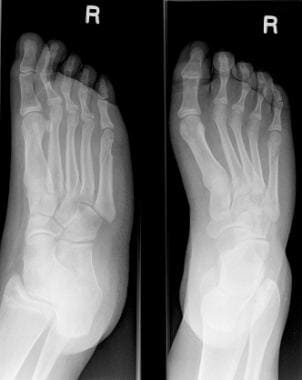 third metatarsal fracture