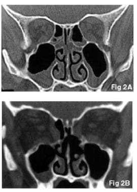 Preoperative coronal noncontrast bone window compu