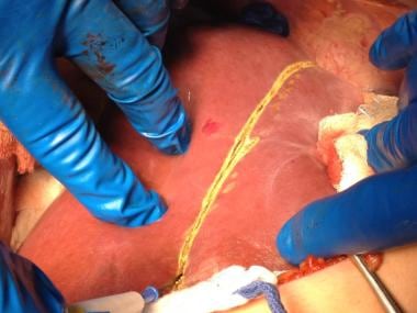 The line of parenchymal dissection has been marked