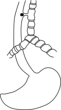 Tracheoesophageal fistula. H-type of tracheoesopha