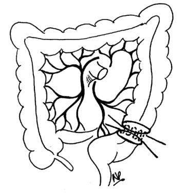 Divided descending colon and rectum are reanastomo