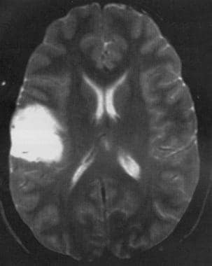 Axial T2-weighted MRI shows a low-grade astrocytom