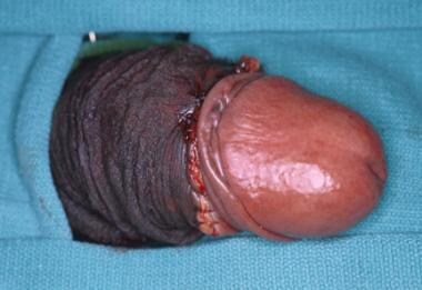 Adult+Circumcision+Procedure dorsal slit or sleeve techniques are commonly used. The dorsal slit ...