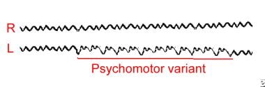 Example of the psychomotor variant (rhythmic harmo