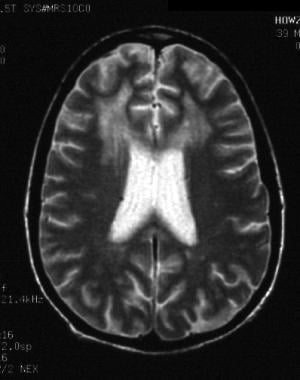 HIV-1 encephalopathy and HIV associated neurocogni