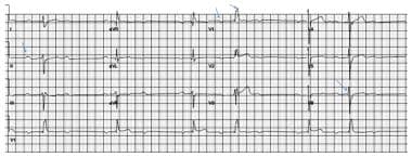 This ECG shows some typical abnormalities that may