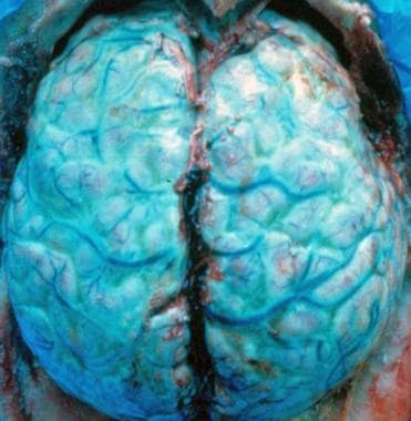 meningitis bacterial infections gross pathology cns purulent staphylococcus brain acute exudates trauma convexity entire showing head after over cerebral associated
