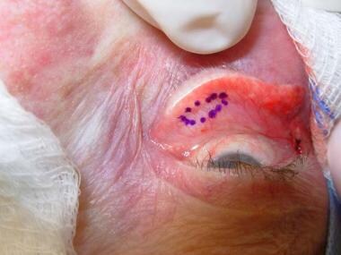 Surgical marker outlines medial spindle of tissue