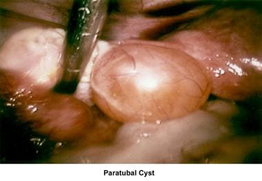 Infertility. Paratubal cyst. Image courtesy of Jai