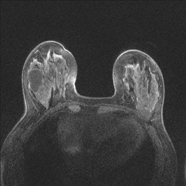 T1-weighted image with fat suppression before cont