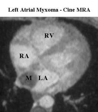 Cine magnetic resonance angiogram shows low signal