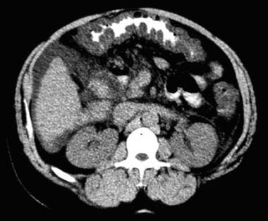 CT findings in a proved case of pseudomembranous c