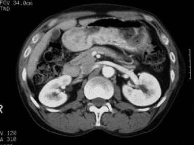 CT scan of a patient with pancreas divisum. Sequen