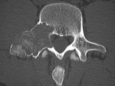 Axial computed tomography scan of a spinal chondro