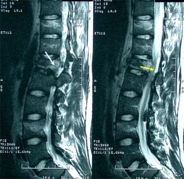 Lumbar spine trauma. A 35-year-old man presented t