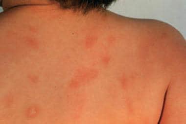 Urticaria pigmentosa lesions on the back of a chil