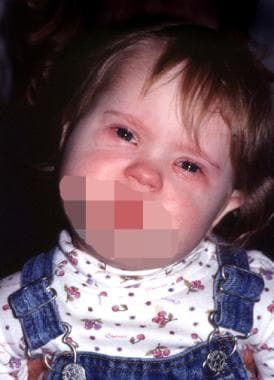 A 2-year-old girl with compensatory left head tilt