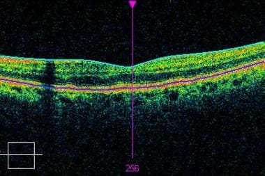 High-definition optical coherence tomography scan