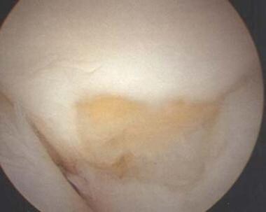 Arthroscopic image of the rim of the sigmoid notch