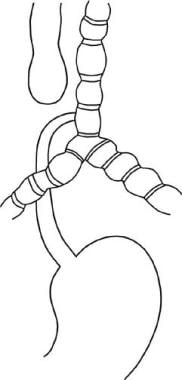 Tracheoesophageal fistula. Esophageal atresia with