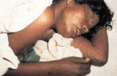 Flat-type smallpox on day 6 of the rash. Courtesy